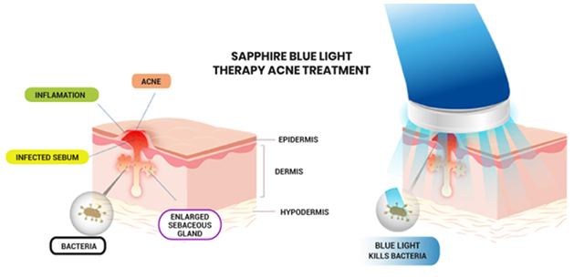 anti blue light treatment