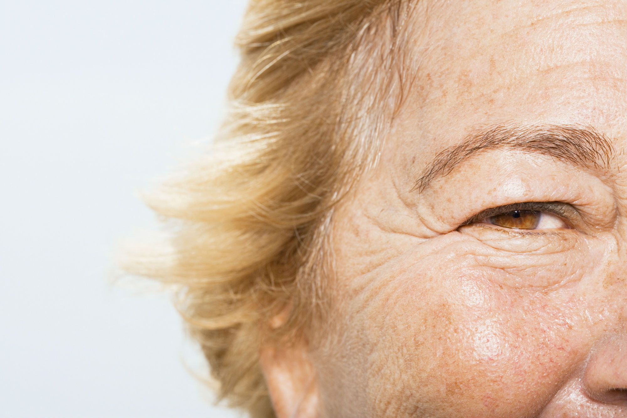 What Type Of Wrinkles Do You Have And How To Treat Them