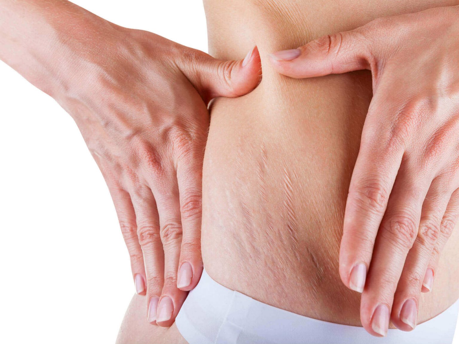 can-you-get-rid-of-stretch-marks