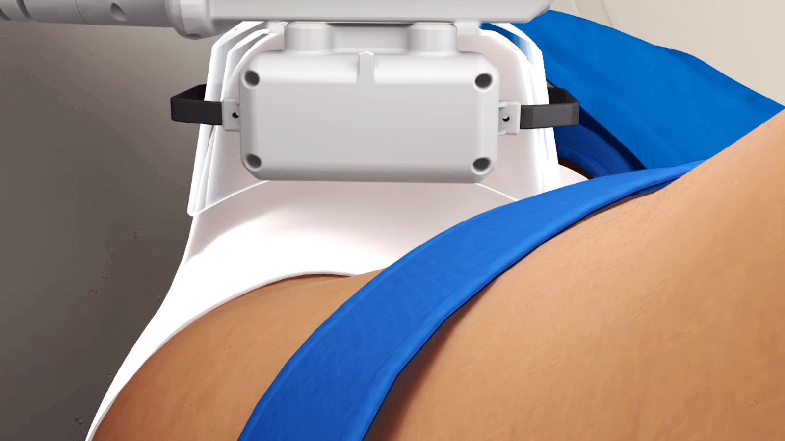 Coolsculpting