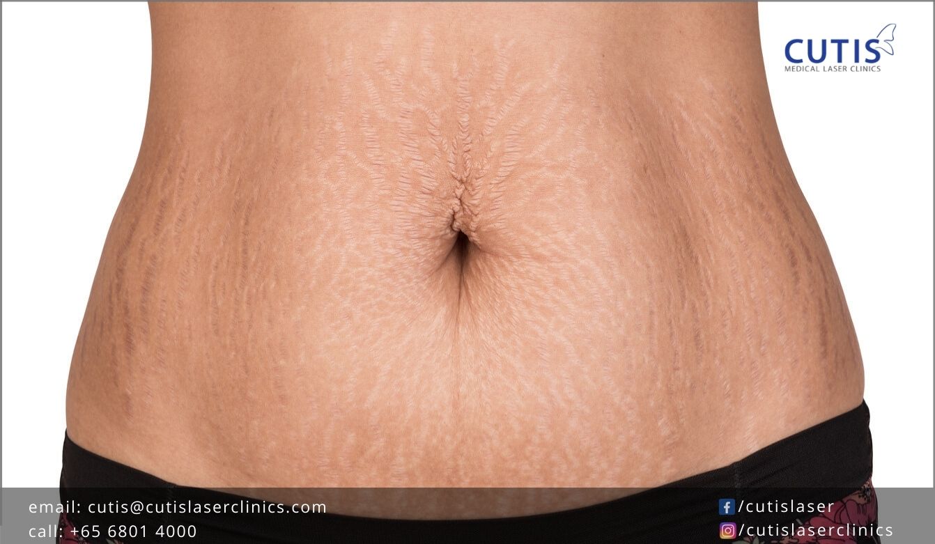 Why Some People Get Stretch Marks And Others Don't