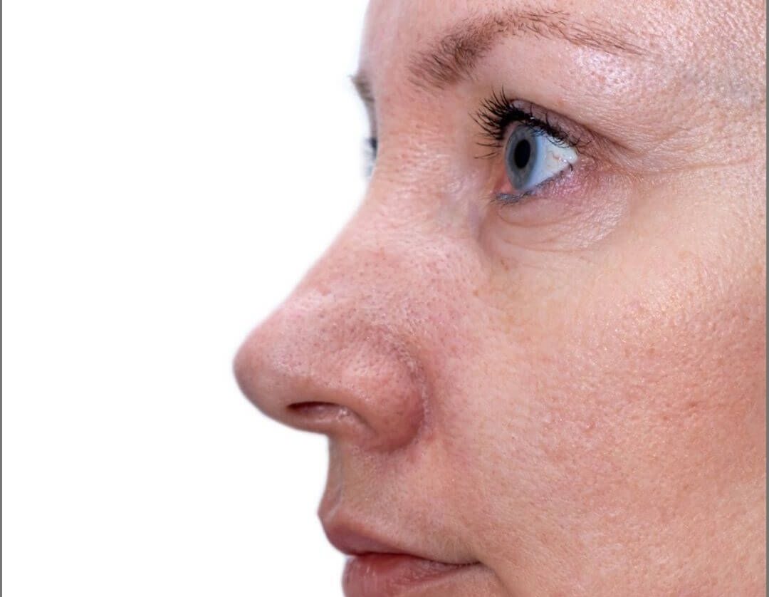 Treat and Improve Skin Imperfections with PicoCare Laser Treatments