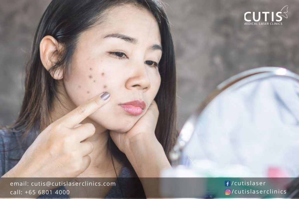 why-your-dark-spots-not-going-away-laser-clinics-in-singapore