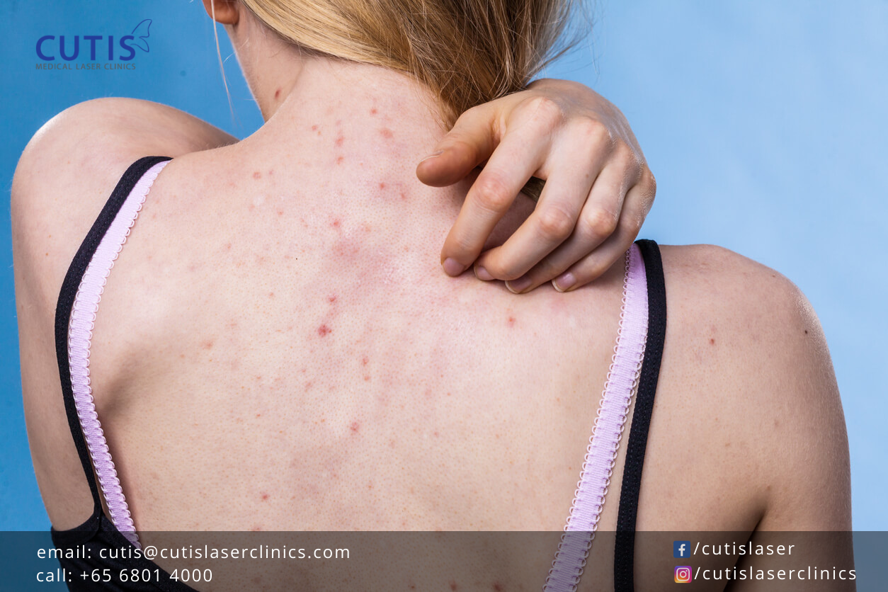 What Can Help With Bacne And Acne Scarring 