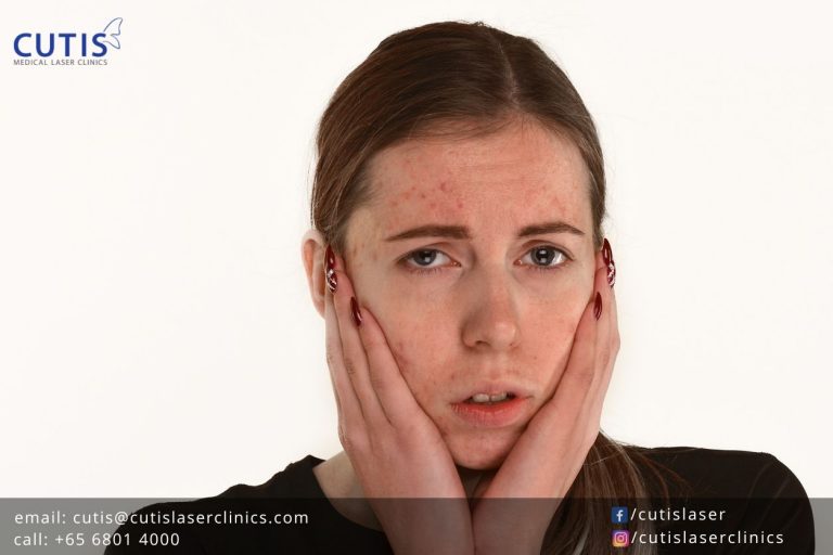 how-to-get-rid-of-acne-and-scars-dr-health-clinic