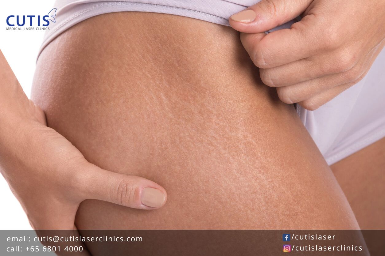 What's the Difference Between Cellulite and Stretch Marks?