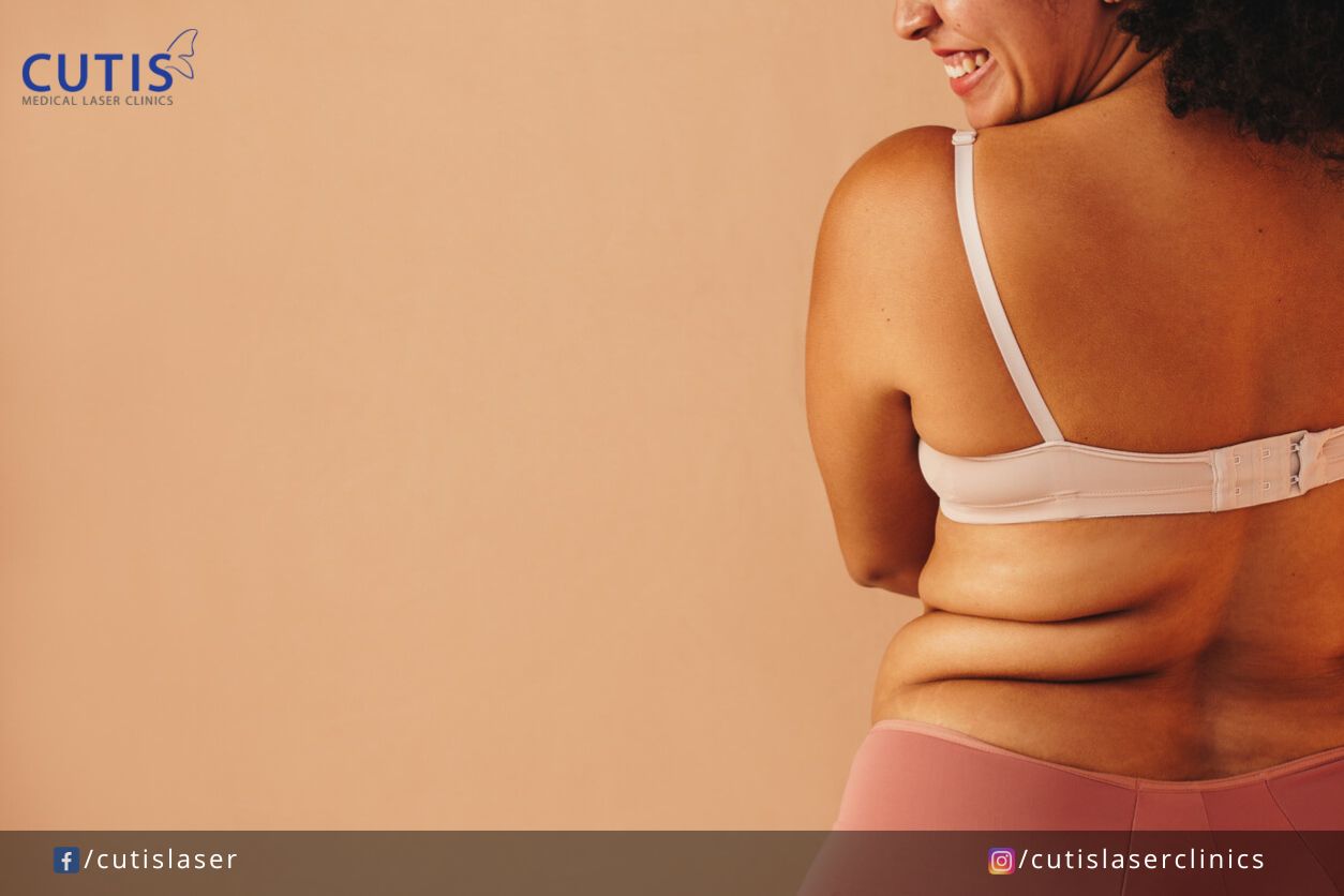 How to Get Rid of a Bra Bulge or Bra Fat in a Simple Way!