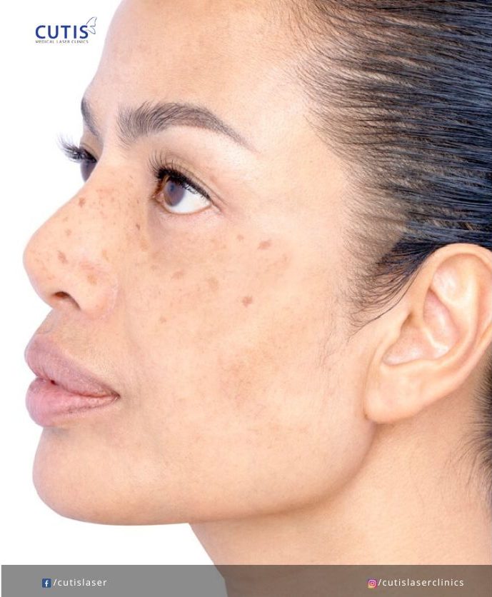 5 Common Mistakes When Treating Pigmentation