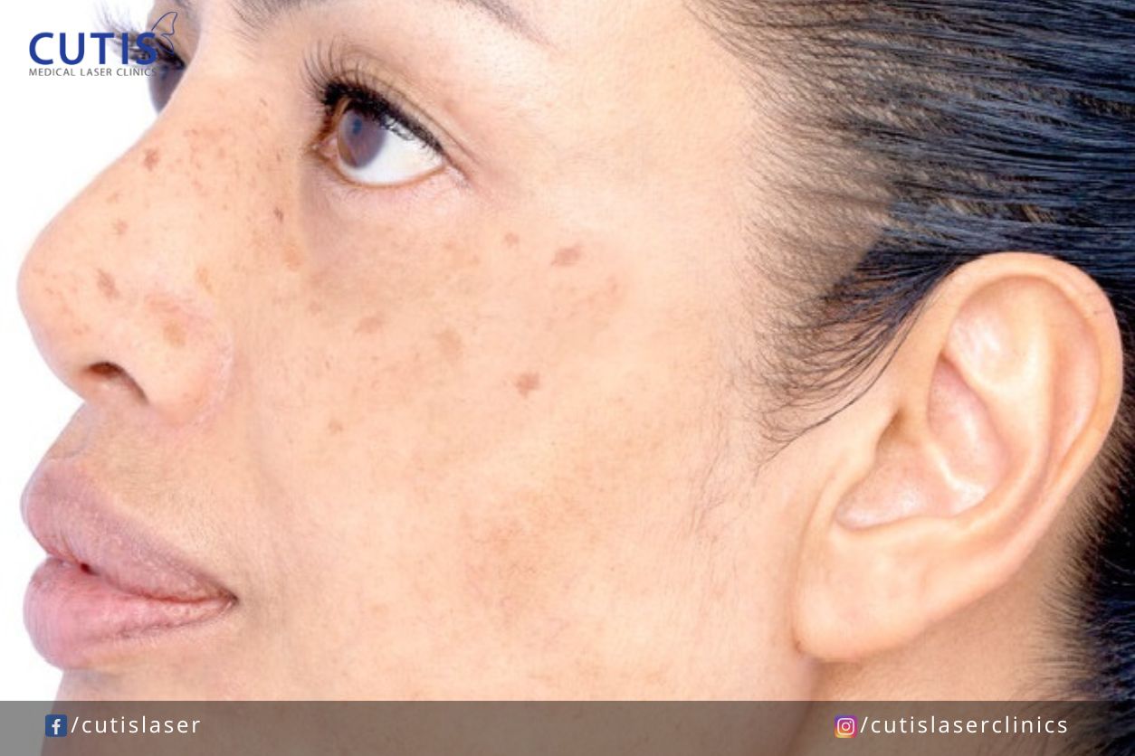 5 Common Mistakes When Treating Pigmentation