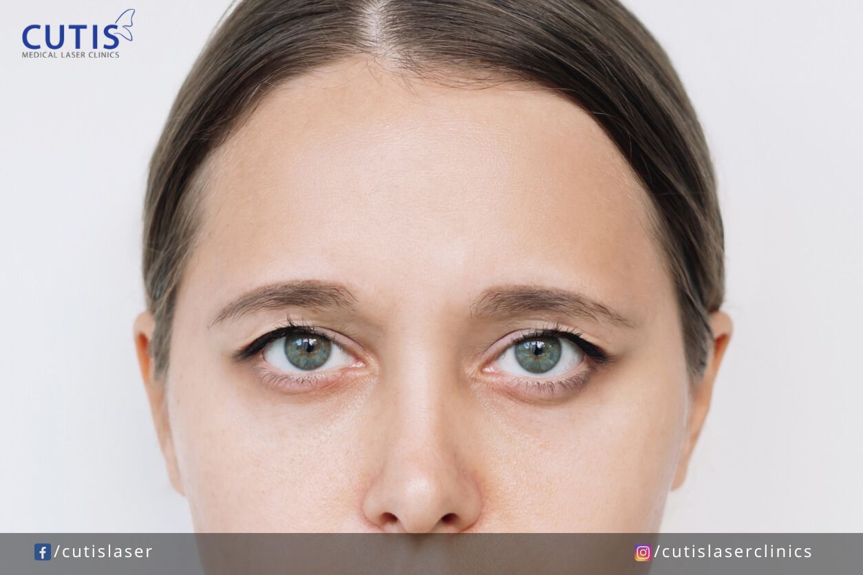 Drooping Eyebrows: The What, Why, and How